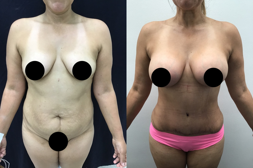 Abdominoplastia (Cirugía de Abdomen)