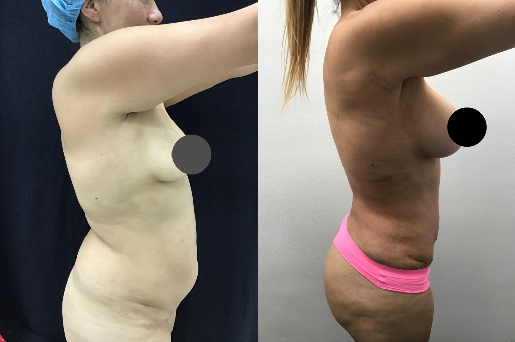 Abdominoplastia (Cirugía de Abdomen)