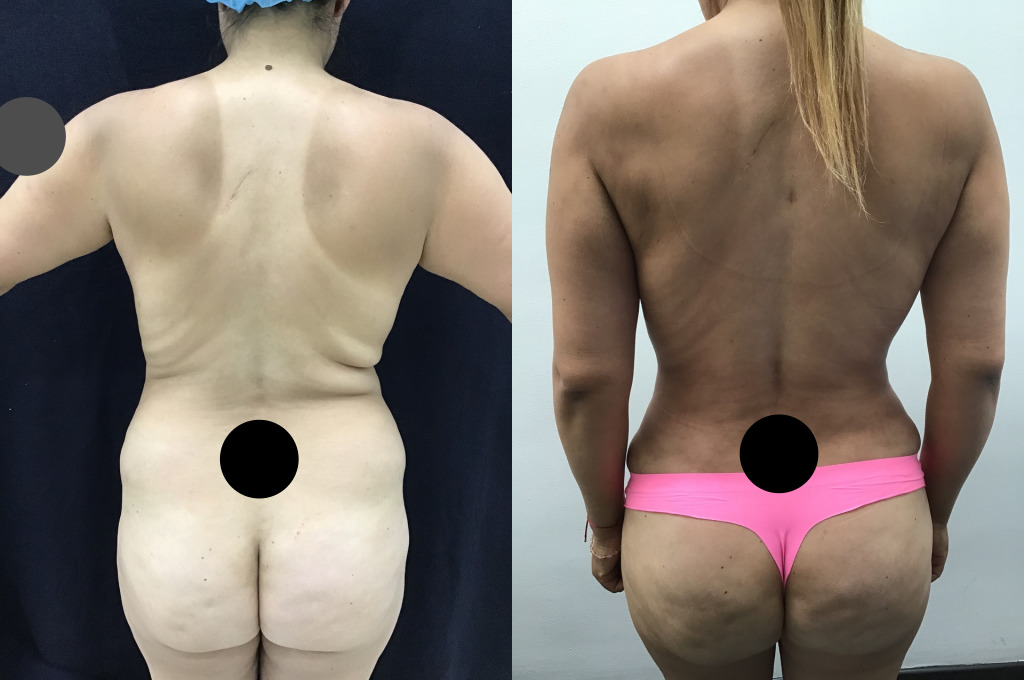 Abdominoplastia (Cirugía de Abdomen)