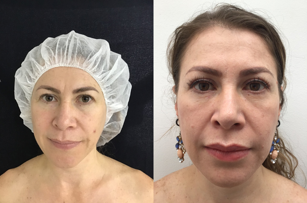 Blefaroplastia (Cirugía de Párpados)