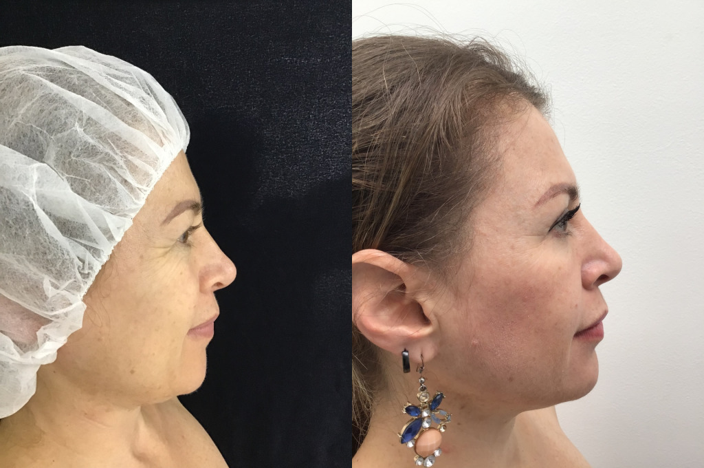 Blefaroplastia (Cirugía de Párpados)