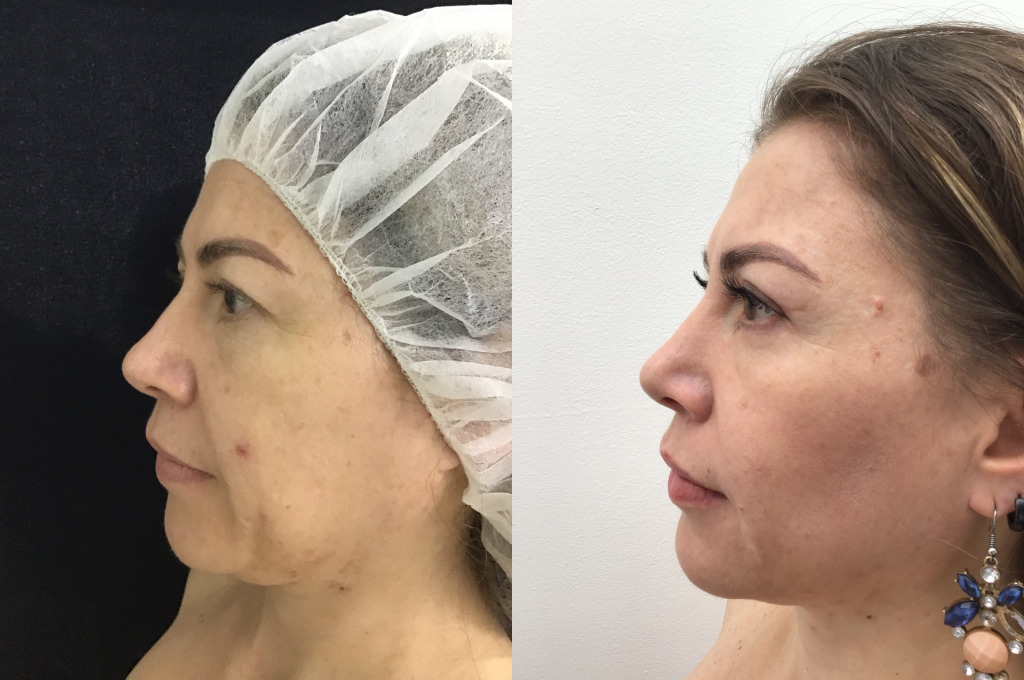 Blefaroplastia (Cirugía de Párpados)