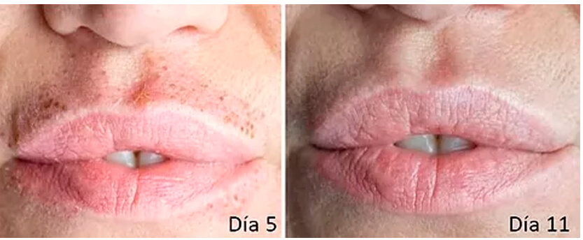 Plasma Pen Liss